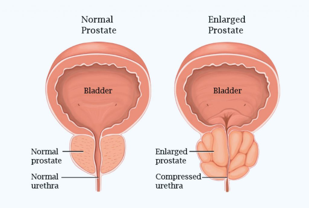 About Prostate Images 2 1024x689 